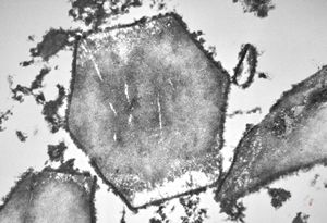 M, | crystalline inclusions in plasmocyte